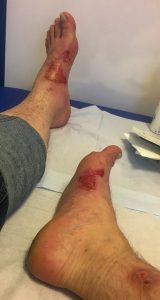 Die Verbrennungen nach 4 Tagen